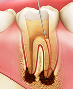 根管治療(歯内療法）