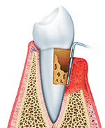 歯周病治療