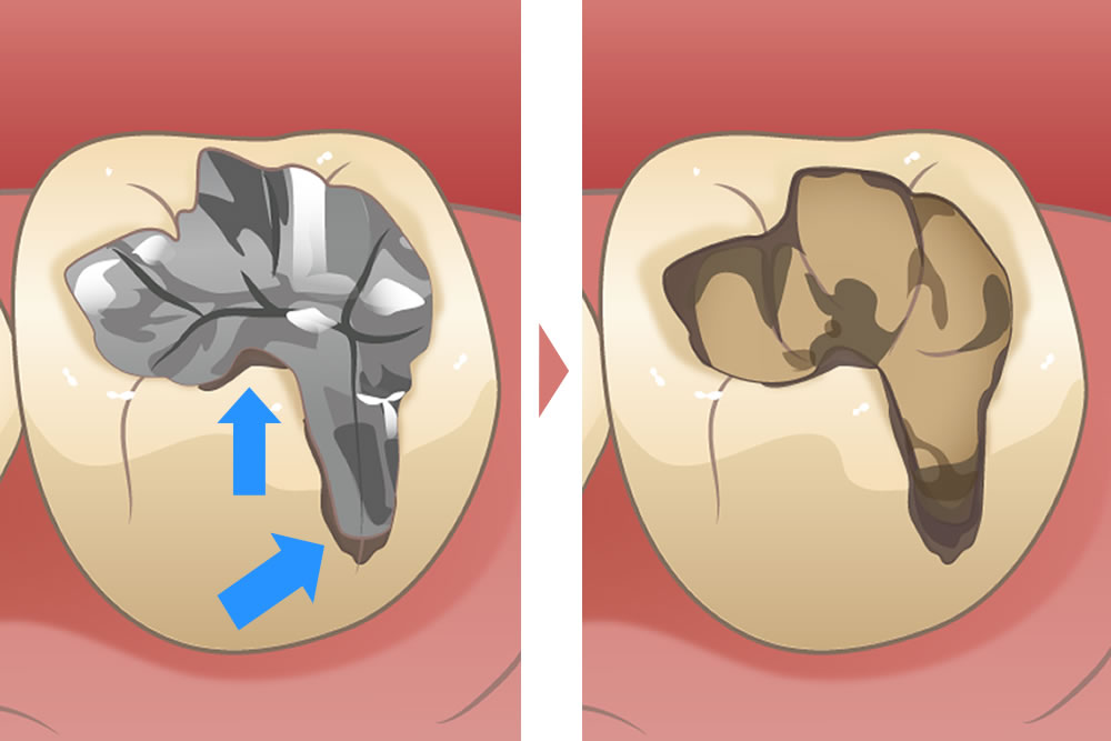 虫歯治療後の虫歯の再発
