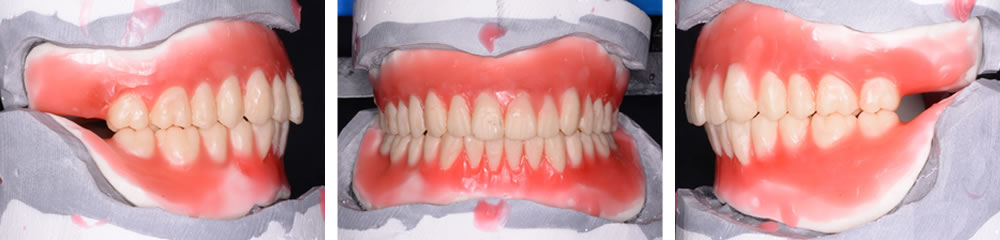 上下治療義歯の製作