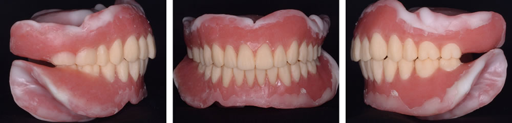 調整が完了した治療義歯