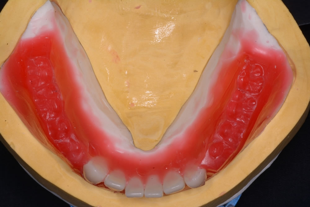 最終的な義歯を作製