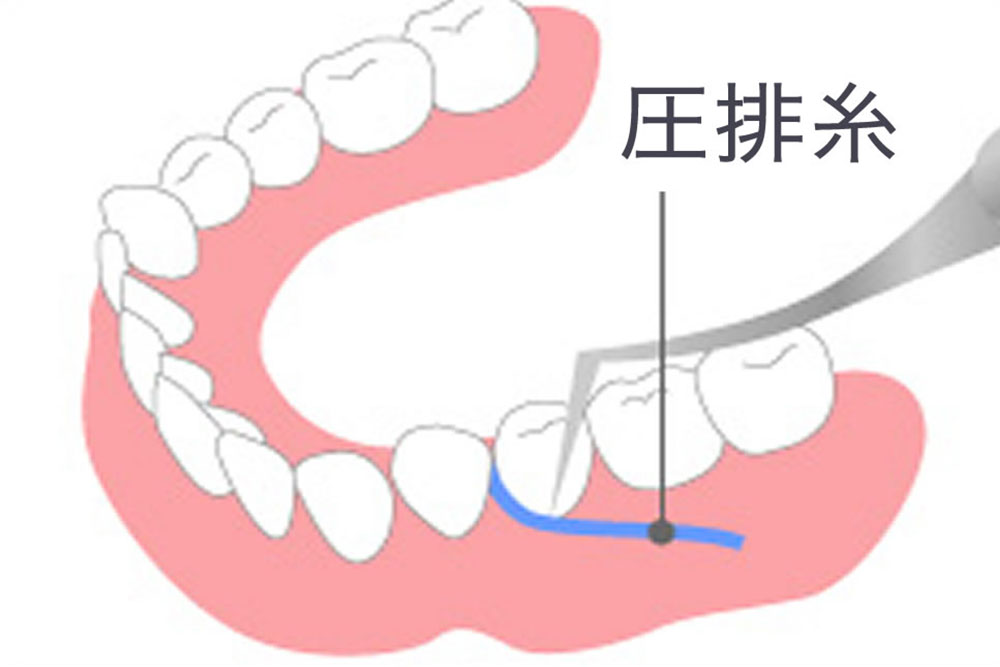 歯肉圧排