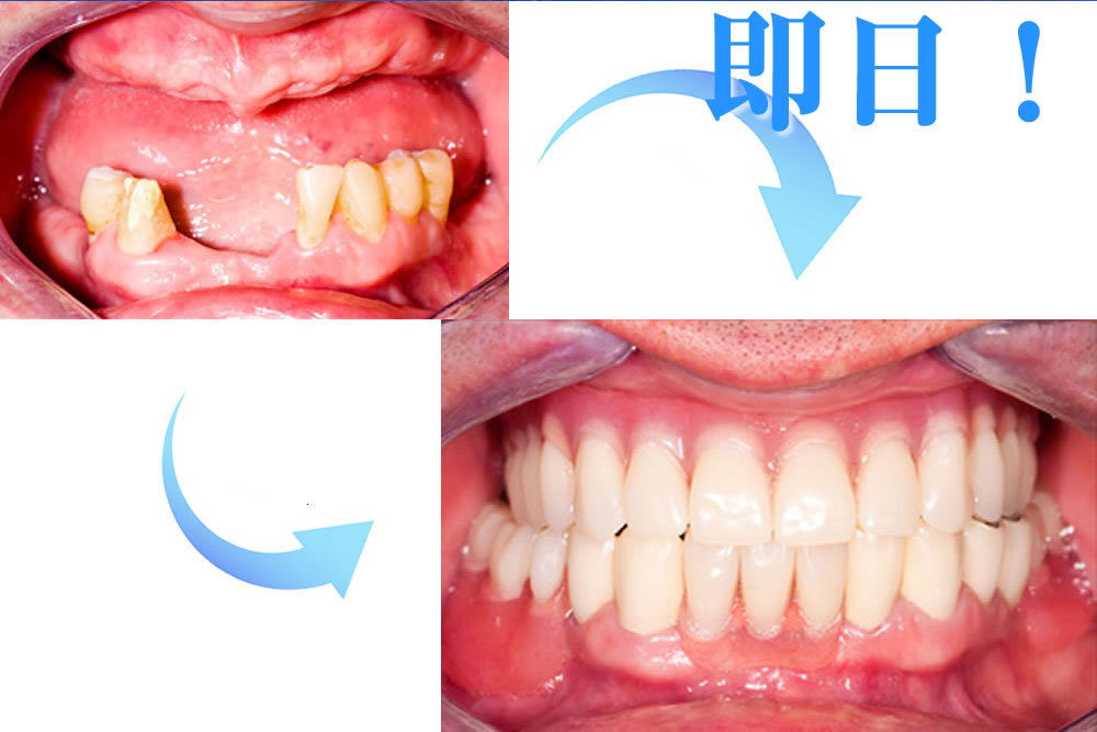 治療期間短縮インプラント