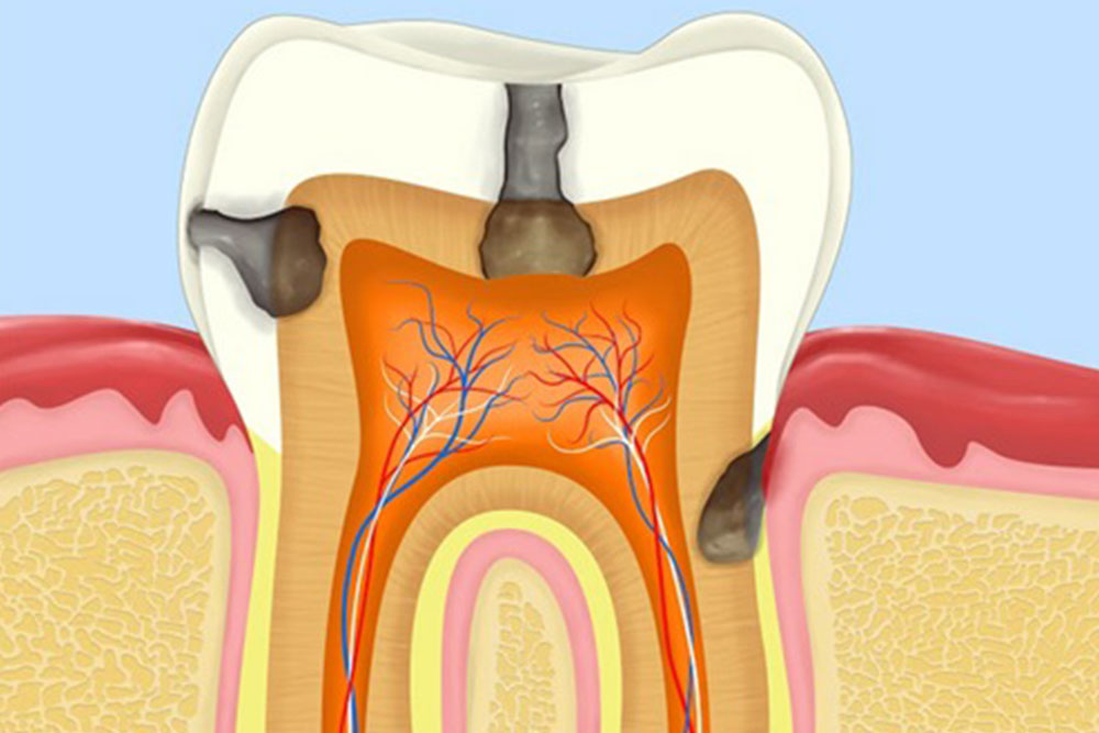 虫歯組織