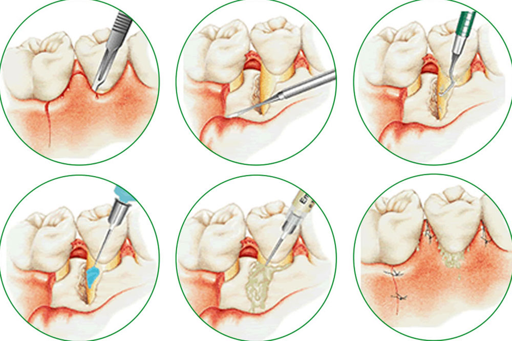 歯周再生療法
