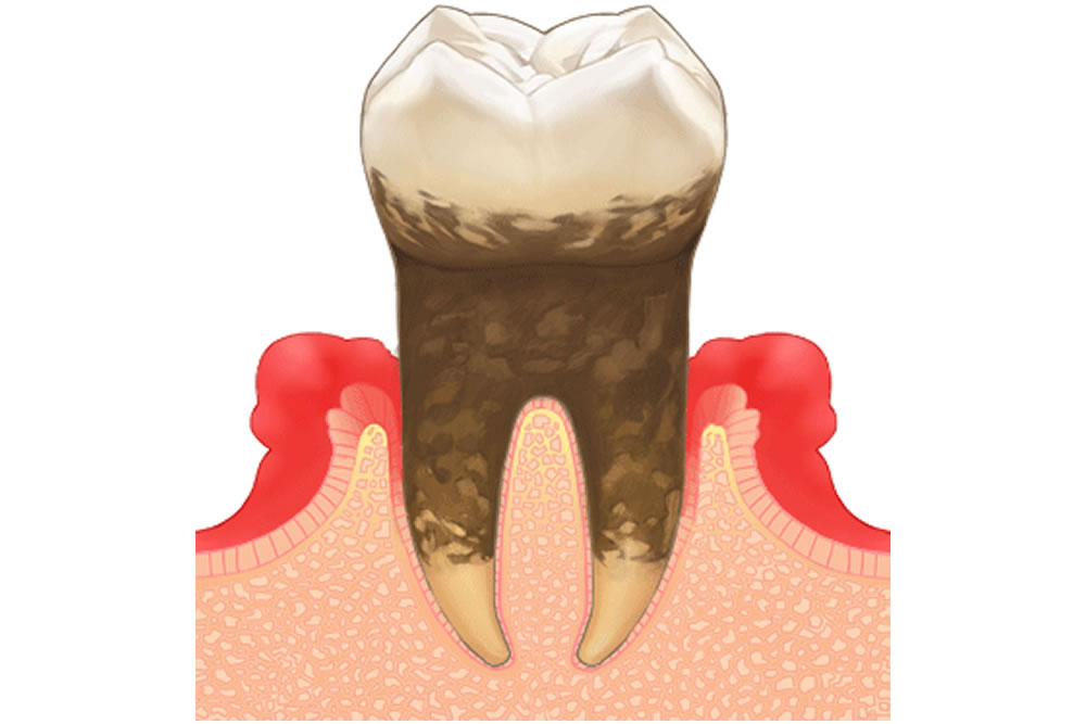 歯周病の再発リスク