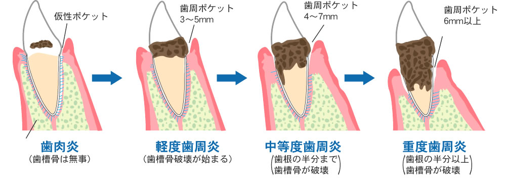 そもそも、歯周病の原因は何？