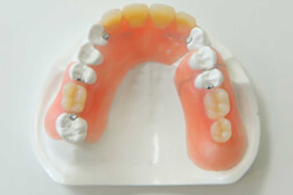 暫間義歯